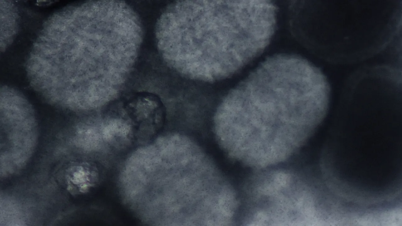 Molluscum contagiousum virus (negative staining)