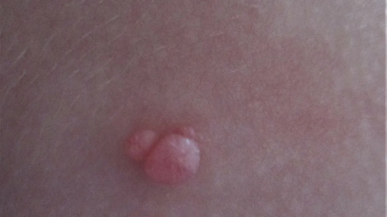 Molluscipoxvirus molluscum