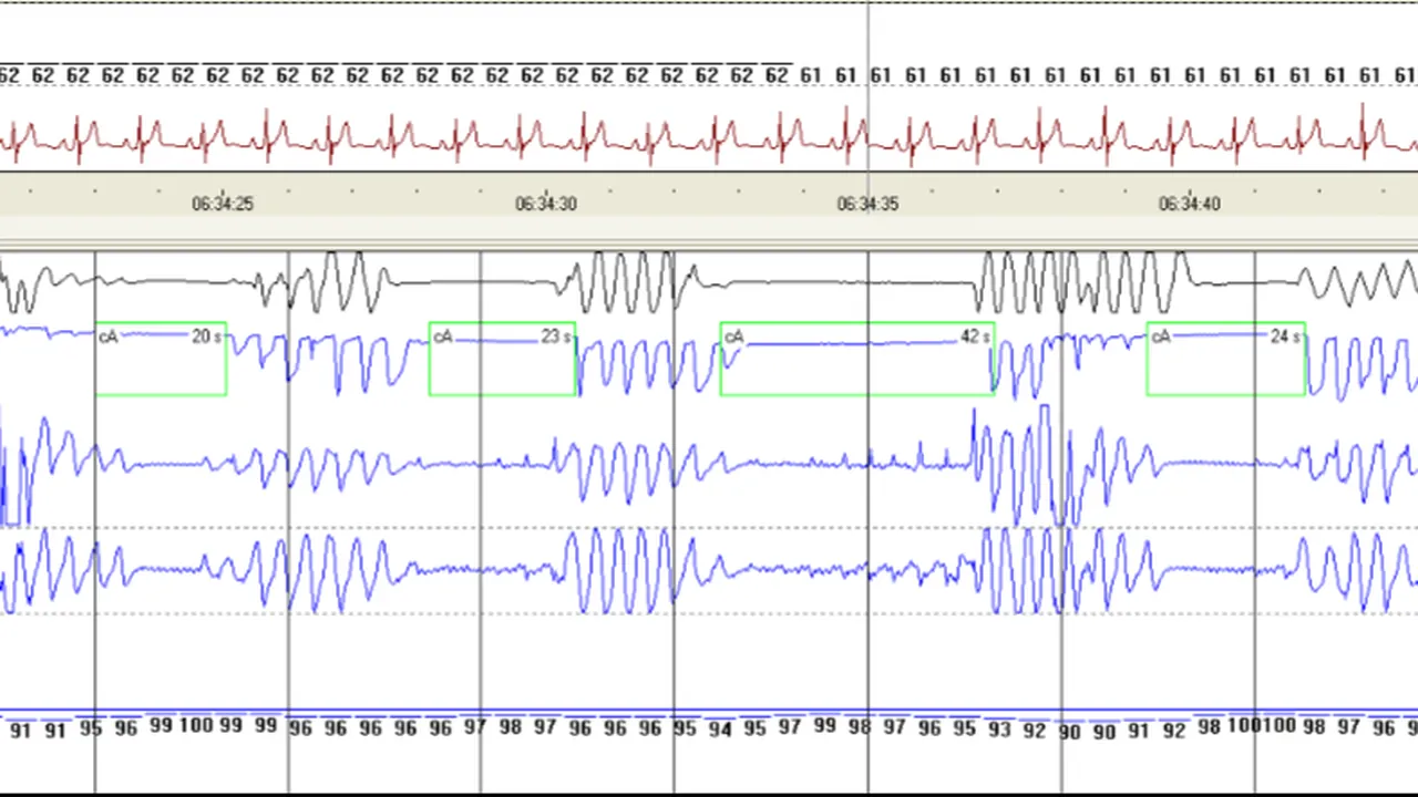 Polysomnography