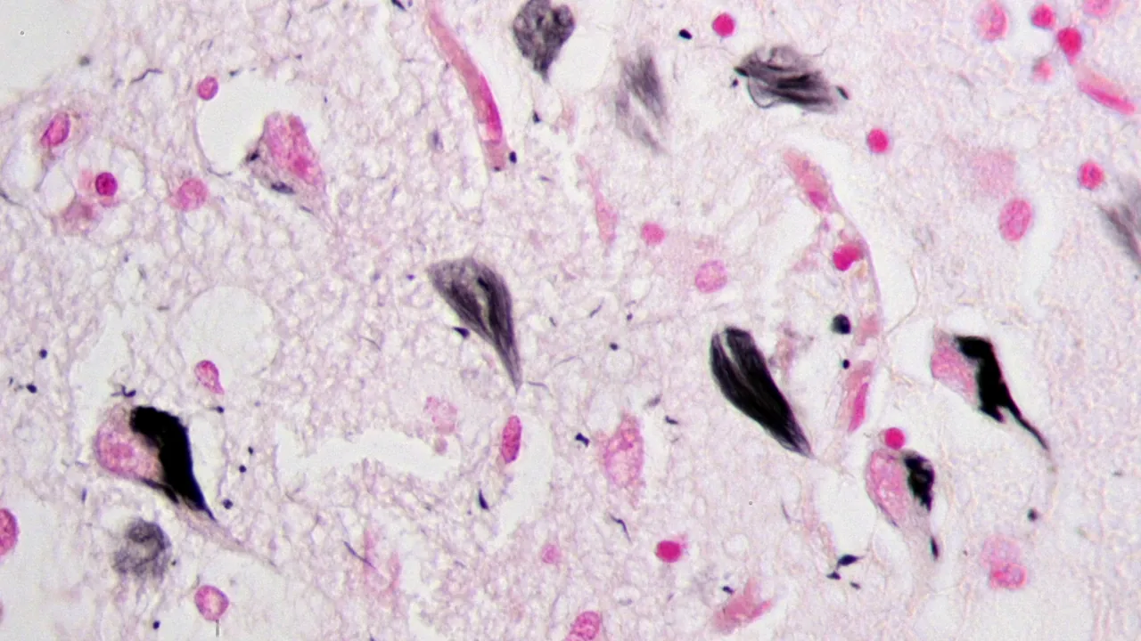 Neurofibrillary tangles in the Hippocampus of an old person with Alzheimer-related pathology, Gallyas silver stain