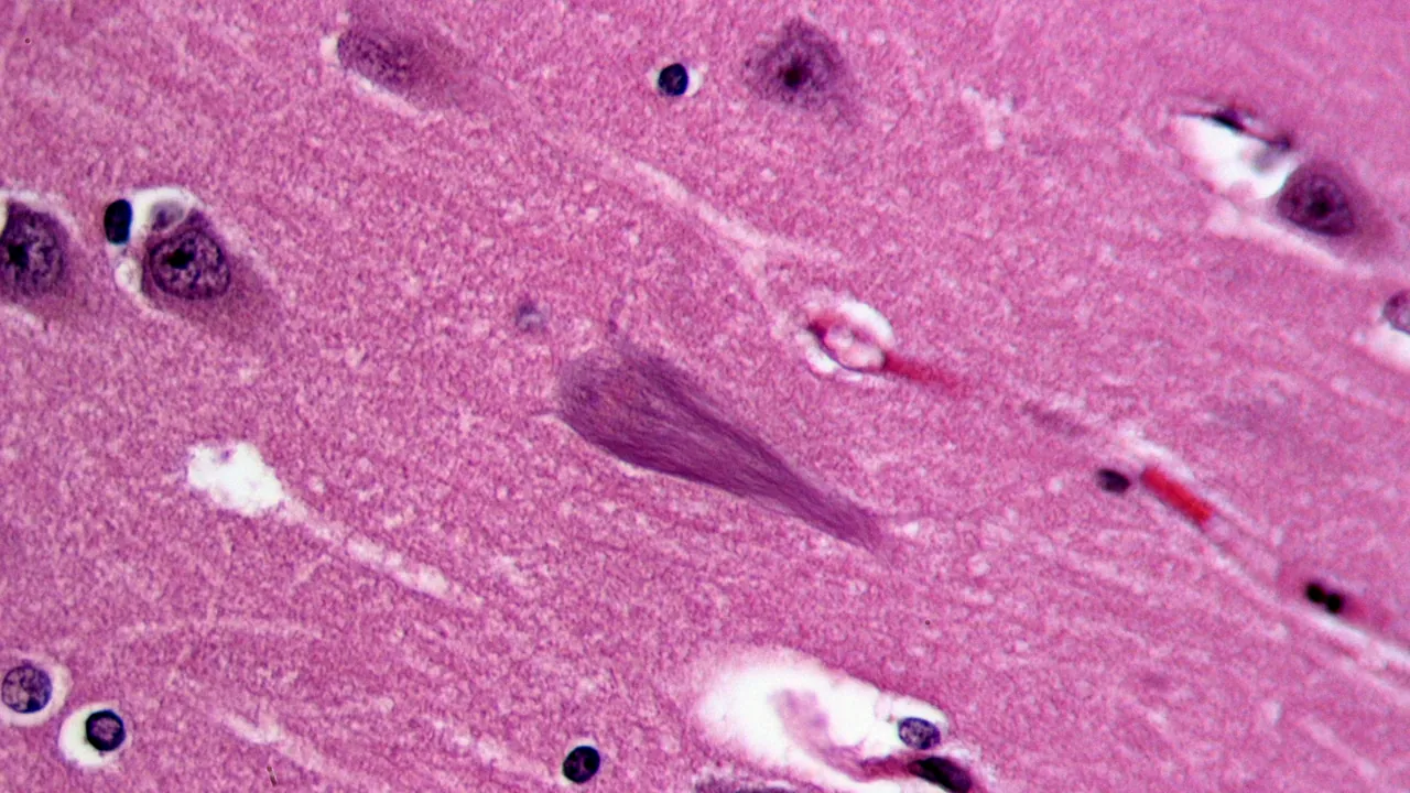 Neurofibrillary tangles in the Hippocampus of an old person with Alzheimer-related pathology, HE 1