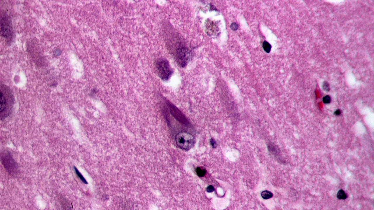 Neurofibrillary tangles in the Hippocampus of an old person with Alzheimer-related pathology, HE 2