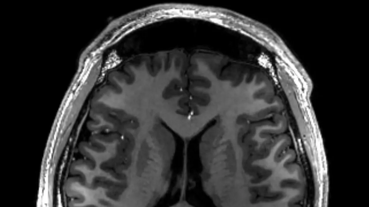 MRI of Human Brain