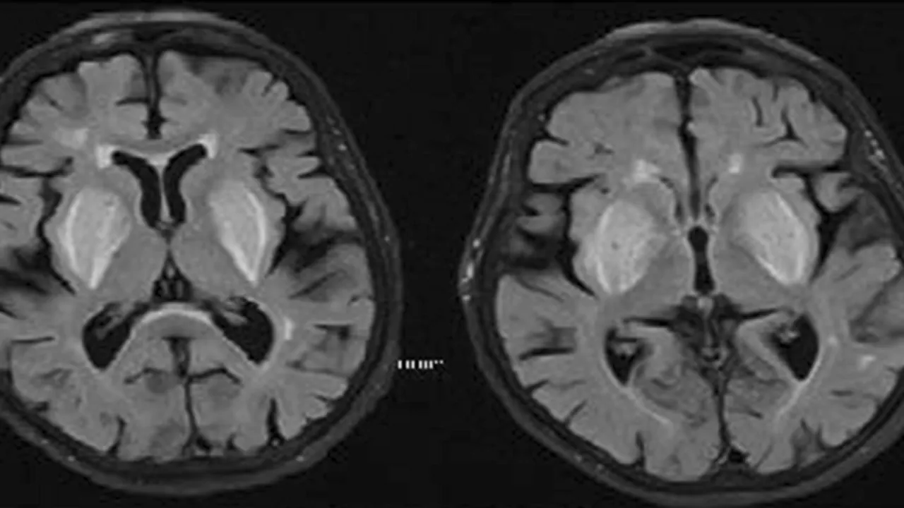 MRI Brain axial FLAIR sequence showing lentiform fork sign