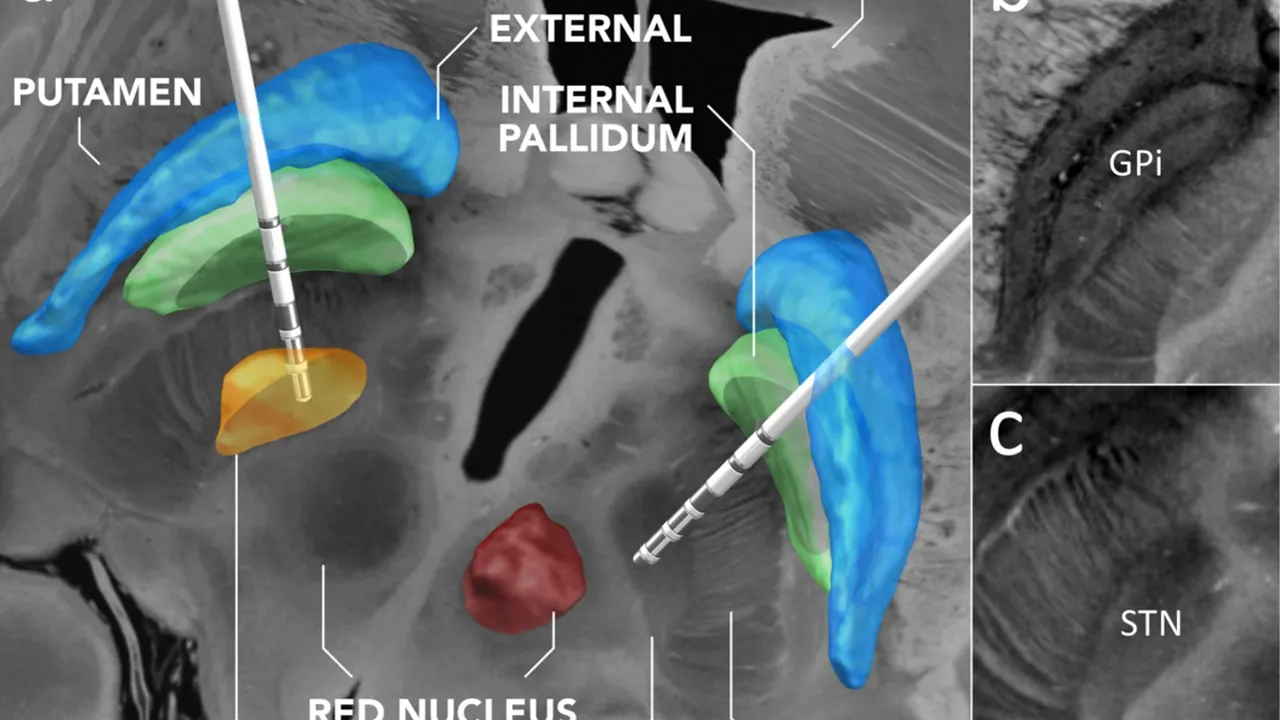 7 Tesla MRI of the ex vivo human brain at 100 micron resolution