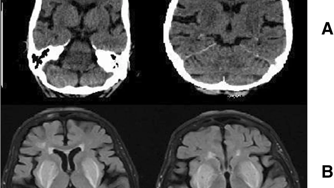 CT scan and MRI brain image of basal ganglia at CKD and AKI patient
