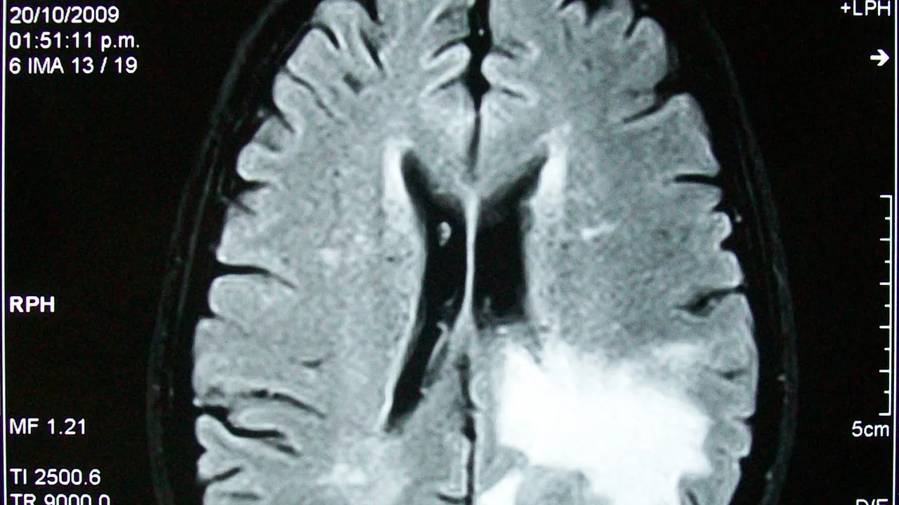 MRI brain tumor