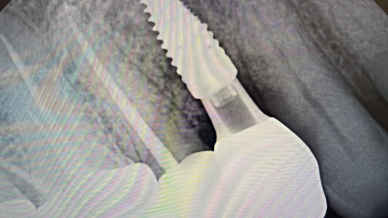 Implant 5