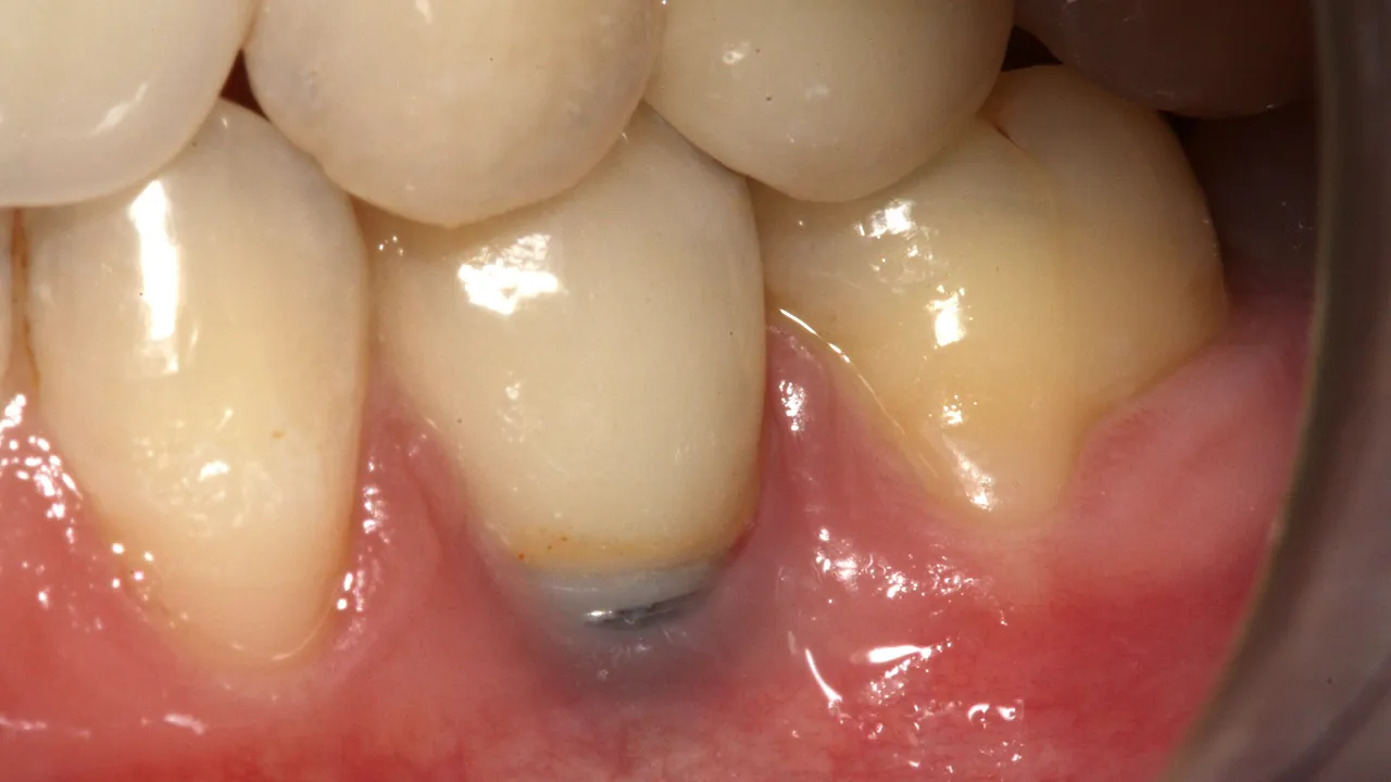 Gingival recession on an implant