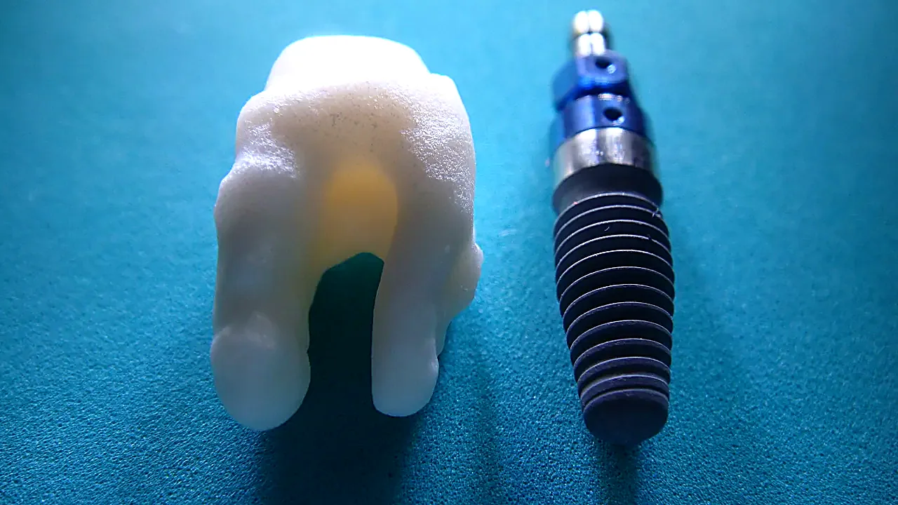 Root analogue ceramic dental implant vs titanium screw type implant