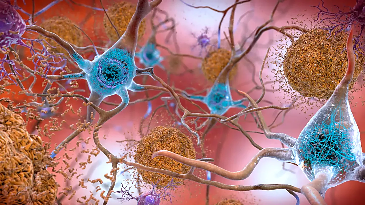Beta-Amyloid Plaques and Tau in the Brain (38686503251)