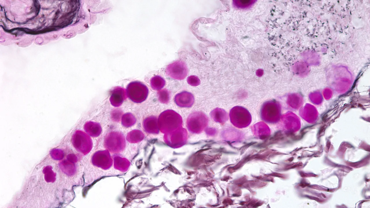 Corpora amylacea in the brain