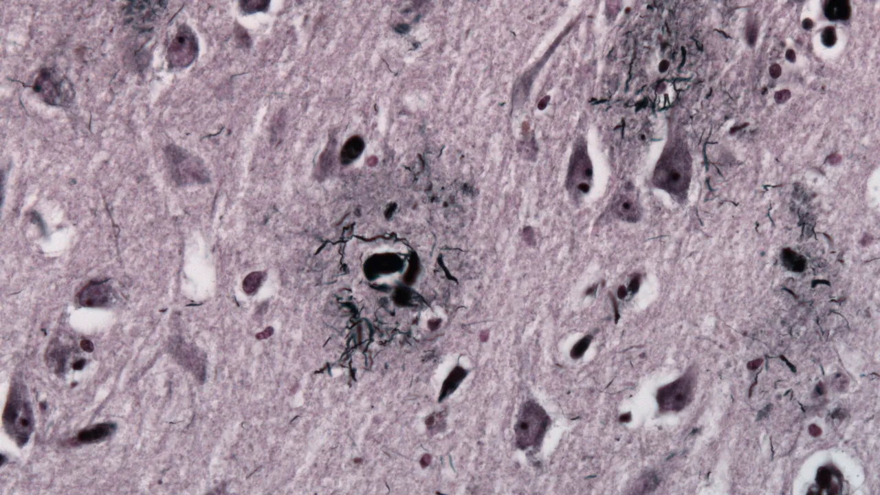 Alzheimer neuritic plaque gallyas stain