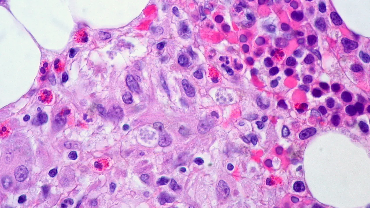 Fungal infection, Bone Marrow (2) (4209118486)