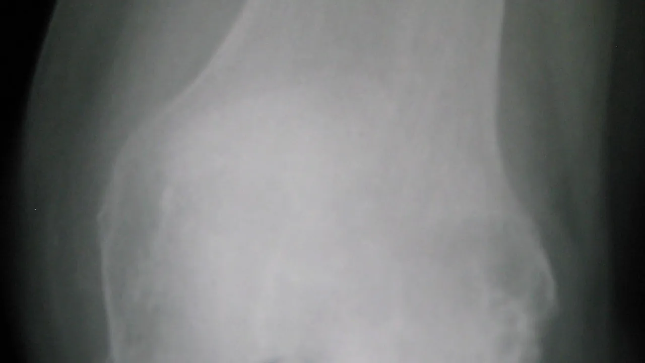 Osteoarthritis left knee