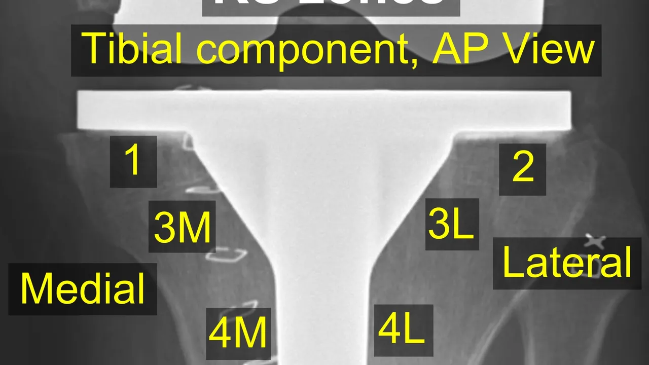 Knee prosthesis zones by Knee Society 2015, AP view