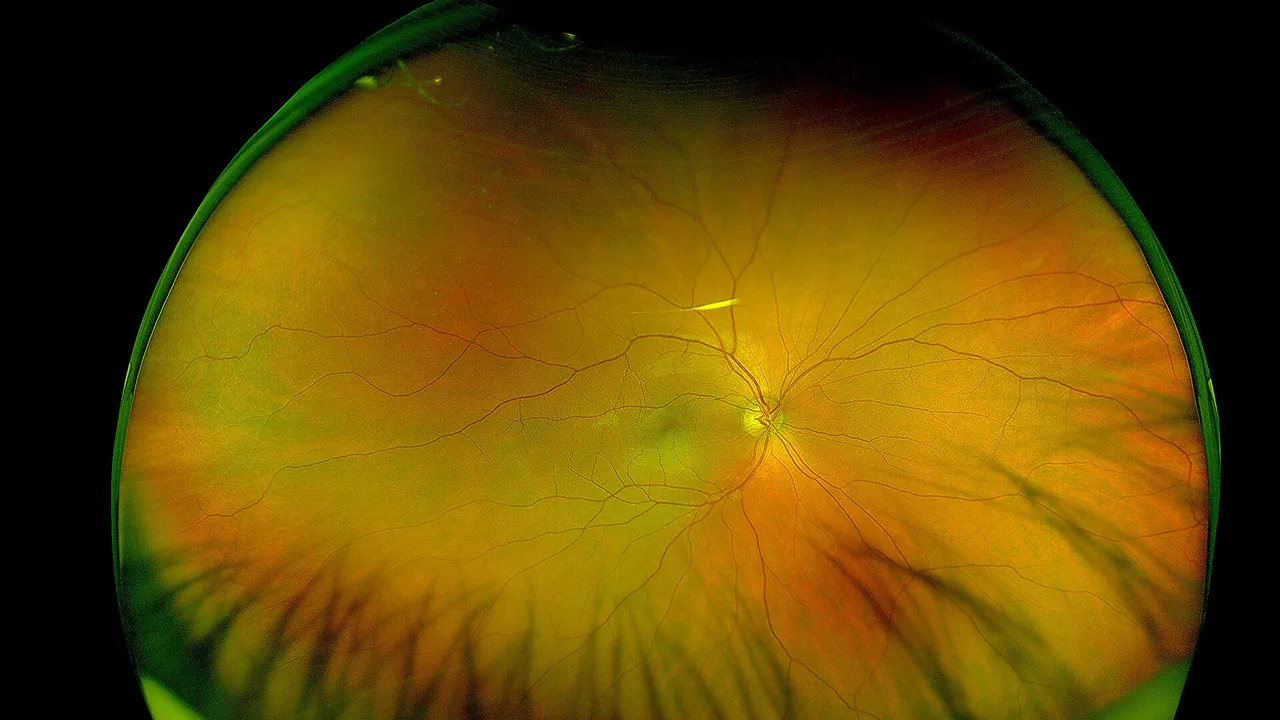 Fundus photo Retina OD