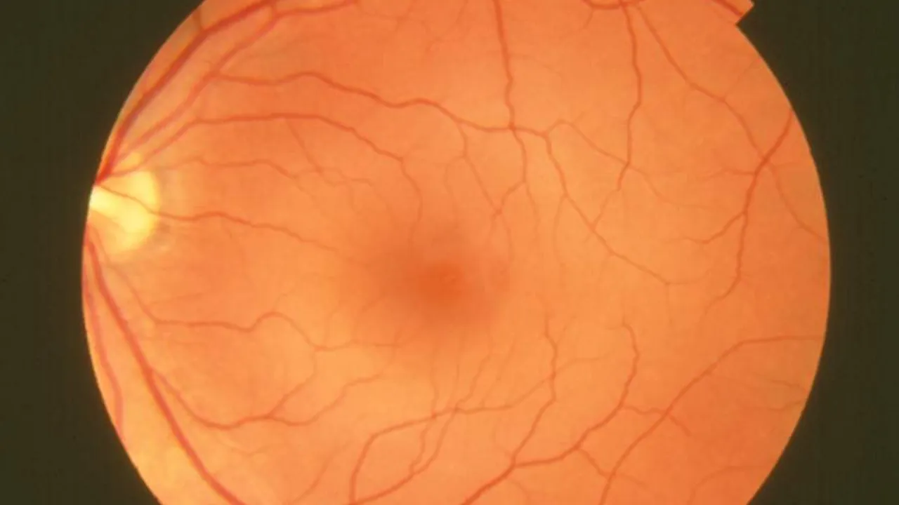 Fundus photograph-normal retina EDA06