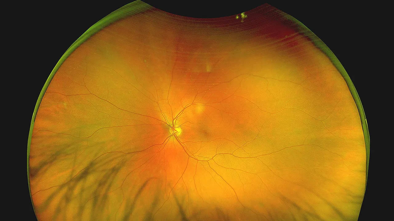 Fundus photograph Retina OS