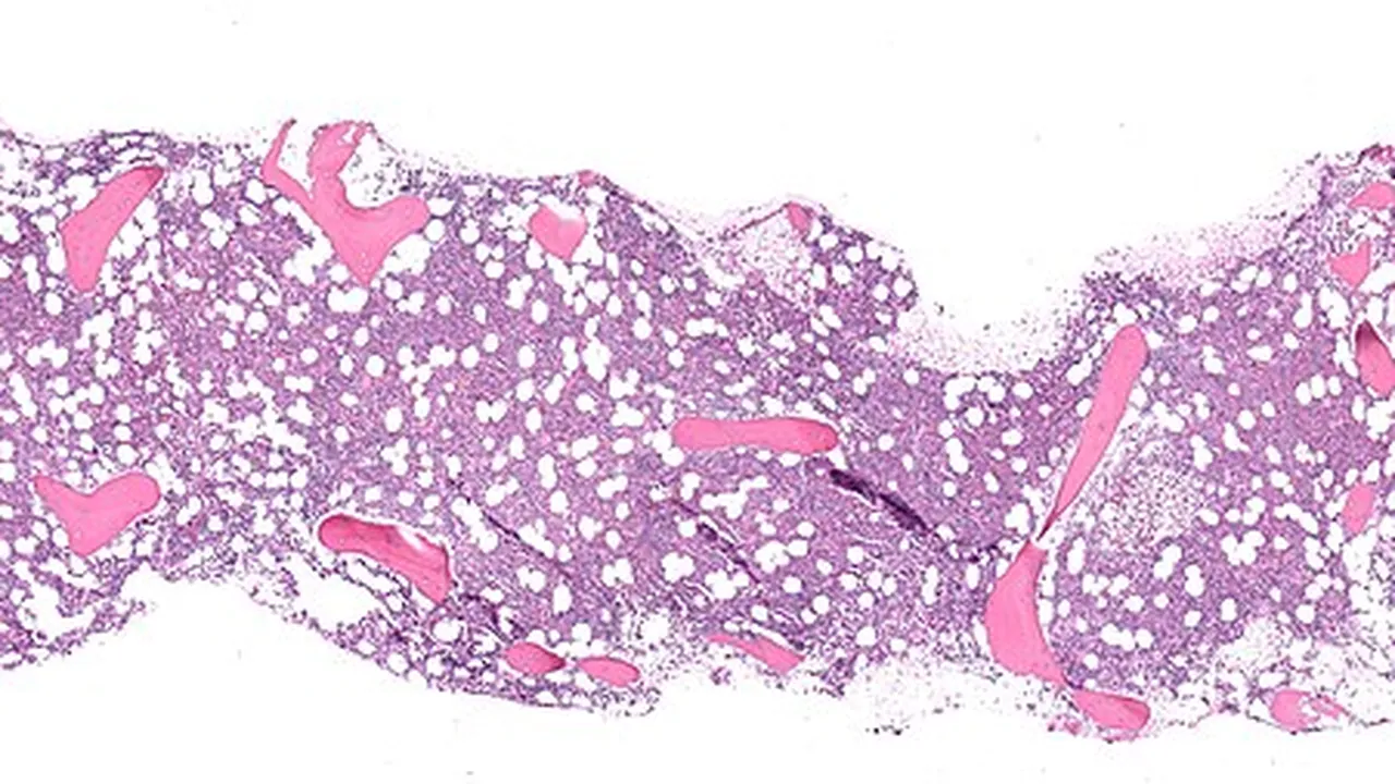Bone marrow core biopsy microscopy (trephine) H&E panorama by gabriel caponetti